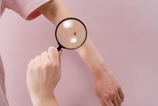 Melanomový den v Nemocnici Kyjov – přijďte si zdarma zkontrolovat znaménka